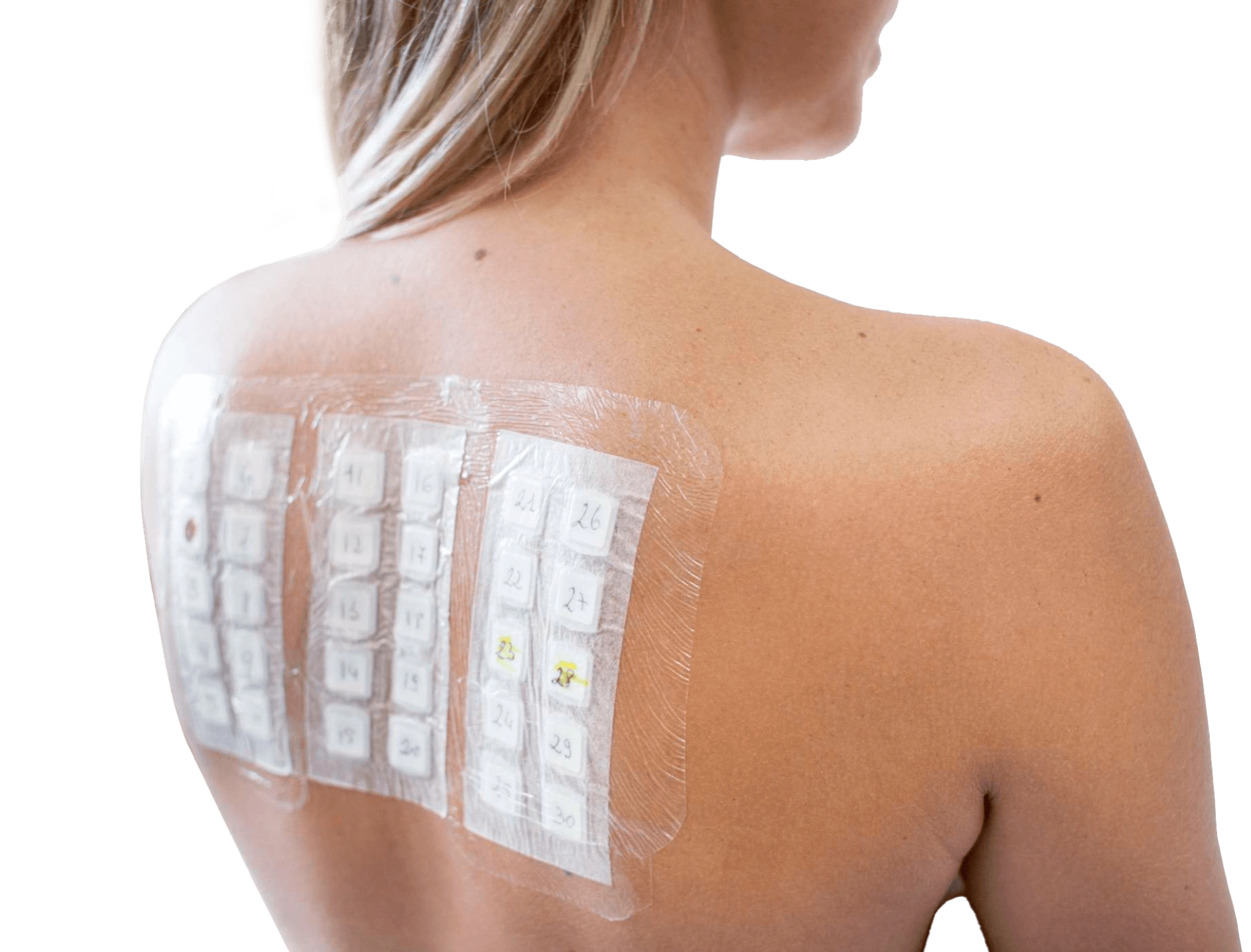 патч тесты на аллергию у женщины на спине